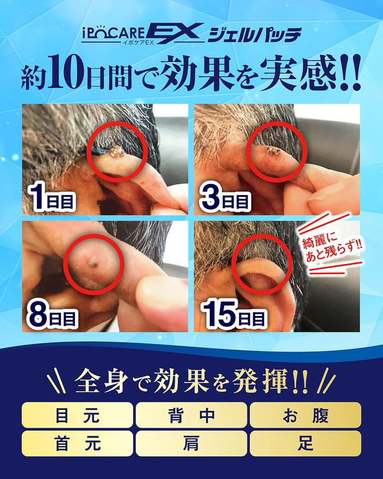 Japan: IPOCARE EX Wart Removal Beauty Gel 25g (B2569)
