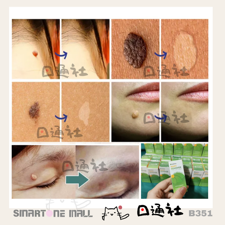 [Made in Japan]: Healthy Wart Removal Essence 10ml (B351)