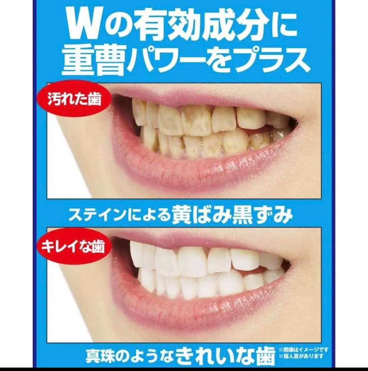 Made in Japan: JUSO Medicated Teeth Whitening Gel (B3006)